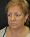 Facelift case #4467