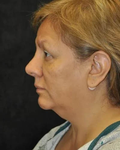 Facelift case #4467