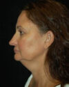 Facelift case #4429
