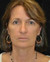 Facelift case #4436