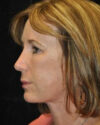 Facelift case #4436