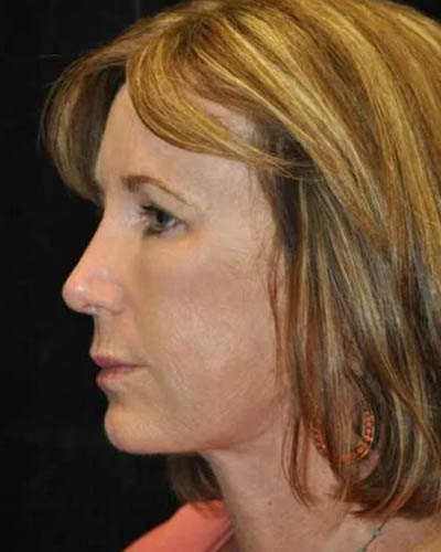 Facelift case #4436