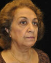 Blepharoplasty case #4443