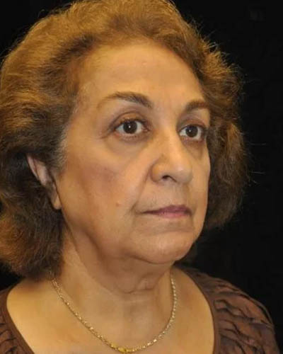 Blepharoplasty case #4443