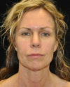 Facelift case #4450