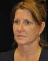 Facelift case #4457