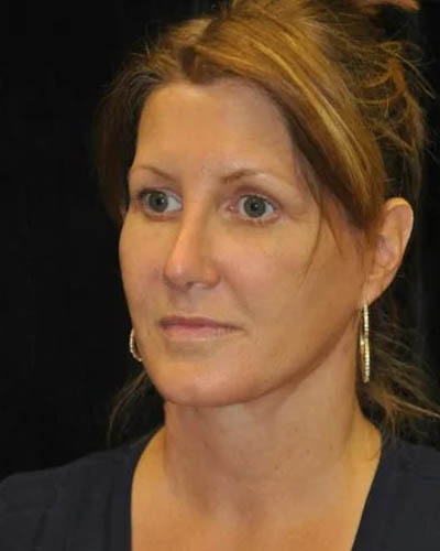 Facelift case #4457