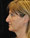 Facelift case #4457
