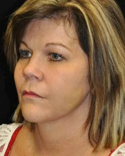 Facelift case #4462