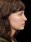 Chin Implant case #4219