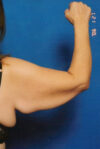 Arm Lift case #3380