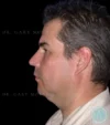 Neck Lift case #4857