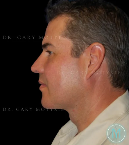 Neck Lift case #4857