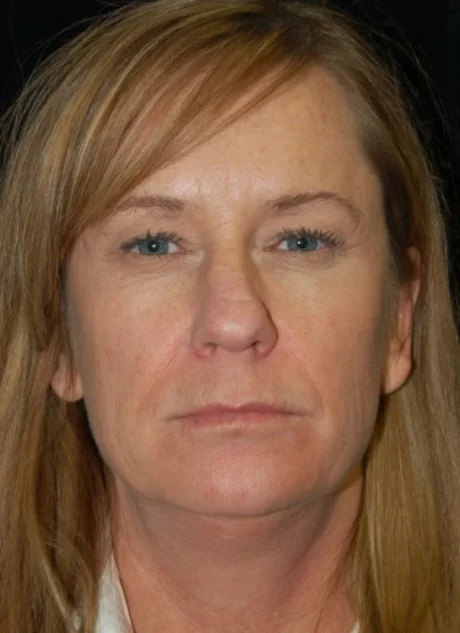 Blepharoplasty case #3480