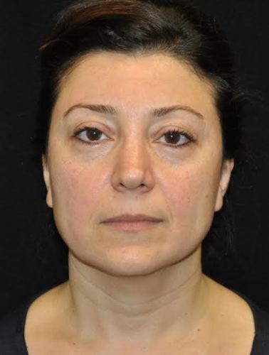 Lower Blepharoplasty case #3439