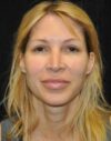 Blepharoplasty case #3517