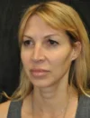 Blepharoplasty case #3517