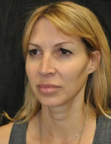 Blepharoplasty case #3517