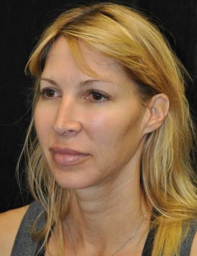 Blepharoplasty case #3517