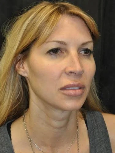 Blepharoplasty case #3517