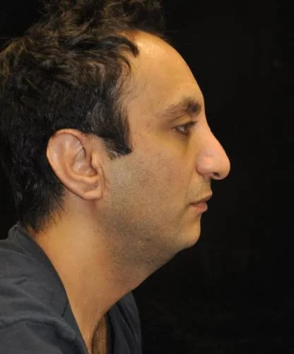 case-11-13-neck-lift-view-3-1