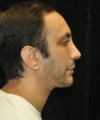 Neck Lift case #4900