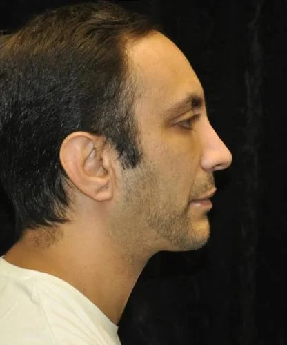 case-11-13-neck-lift-view-3-2
