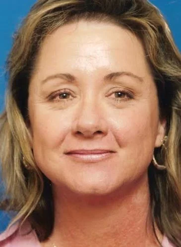 Blepharoplasty case #3524