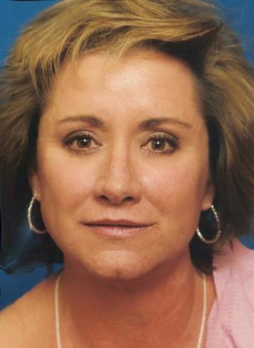 Blepharoplasty case #3524
