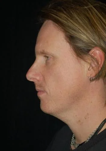 Neck Lift case #4907