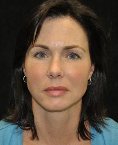 Lower Blepharoplasty case #3449