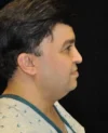 Neck Lift case #4912