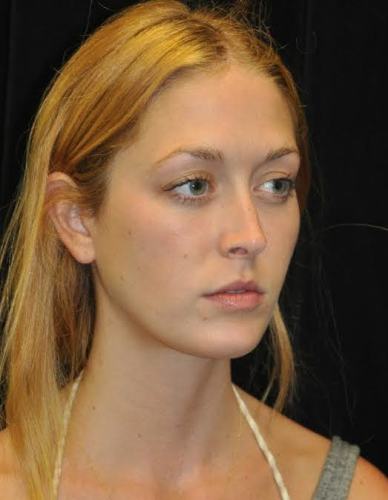 Lower Blepharoplasty case #3459
