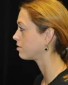 Lower Blepharoplasty case #3459