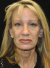 Blepharoplasty case #3538