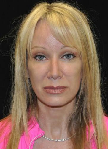 Blepharoplasty case #3538