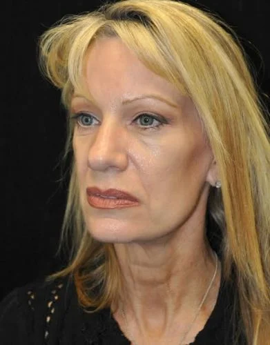 Blepharoplasty case #3538
