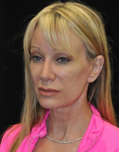 Blepharoplasty case #3538