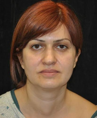 Lower Blepharoplasty case #3467