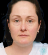 Lower Blepharoplasty case #3472