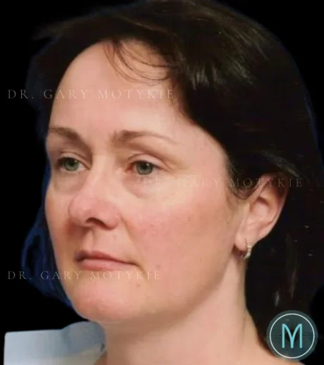 Lower Blepharoplasty case #3472
