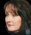 Lower Blepharoplasty case #3472