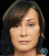 Lower Blepharoplasty case #3477