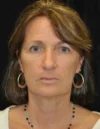 Blepharoplasty case #3548