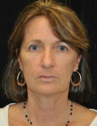 case-17-9-blepharoplasty-upper-eyelid-lift-view-1-1