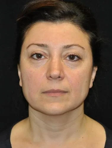 case-19-7-blepharoplasty-upper-eyelid-lift-view-1-1