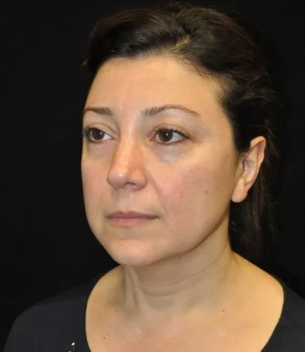 Blepharoplasty case #3553