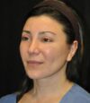 Blepharoplasty case #3553