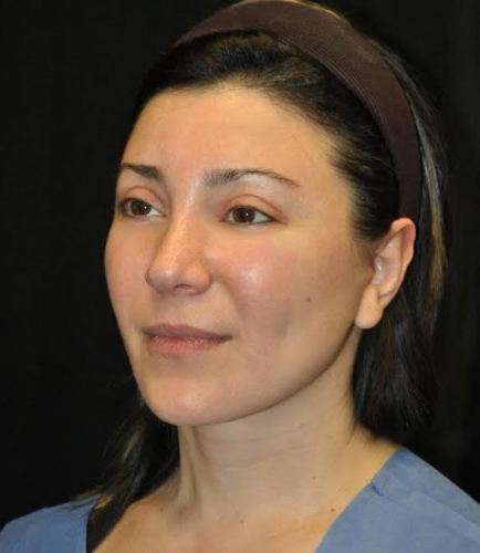 Blepharoplasty case #3553