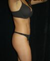Brazilian Butt Lift case #3570